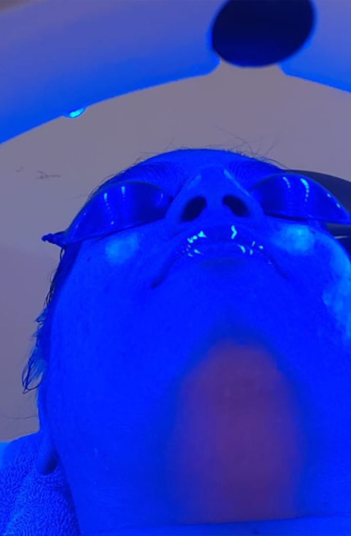 Step 13: Blue light led therapy was done, reducing redness and inflammation in the skin.